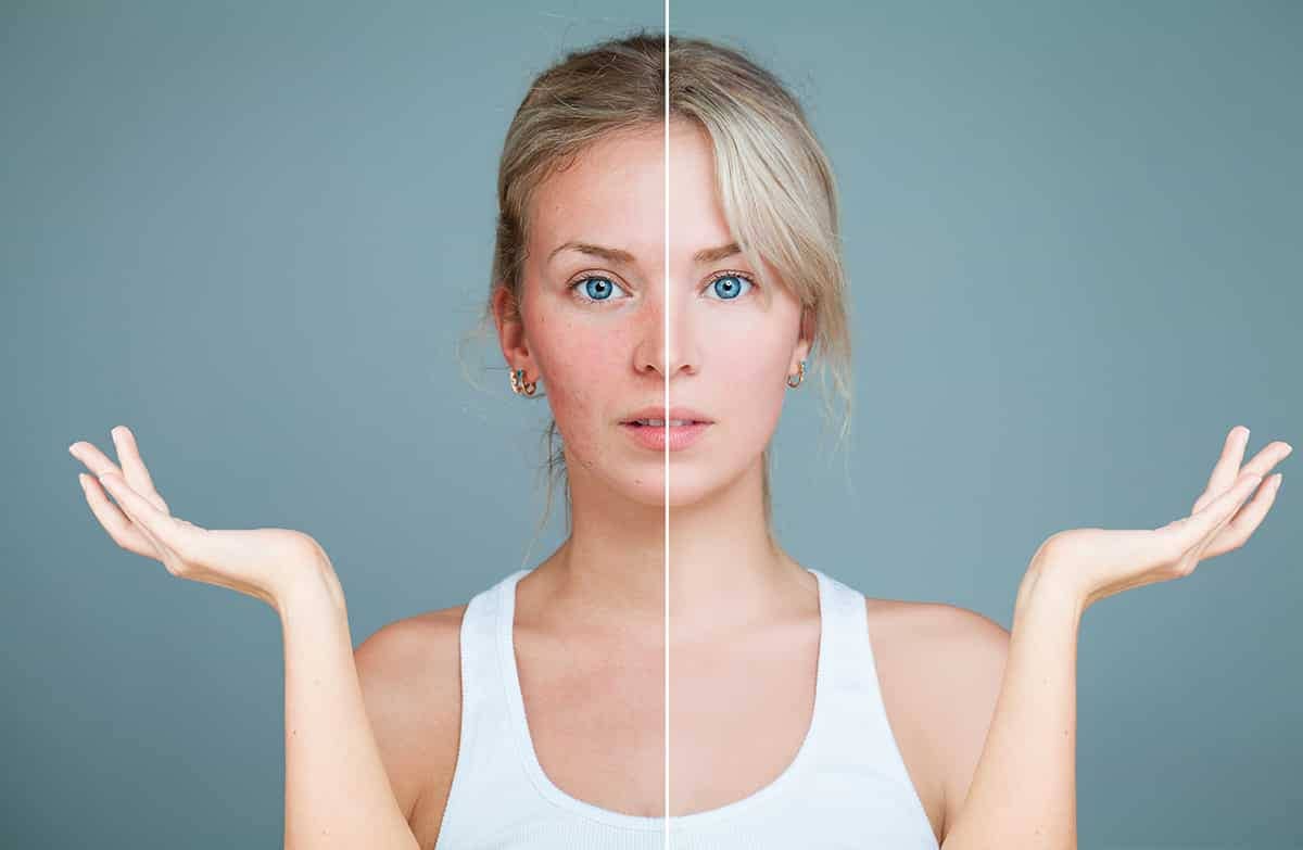 Skincare options for rosacea.