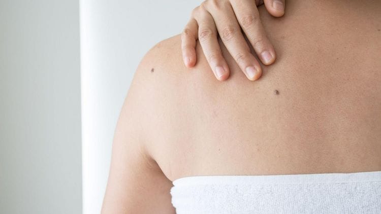 What is Melanoma